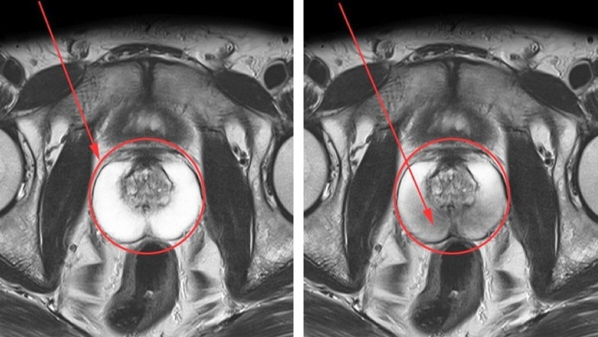 Ecografia per prostatite cronica – prostata sana (a sinistra) e infiammata (a destra)