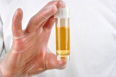 L'analisi delle urine è uno dei metodi per diagnosticare la prostatite