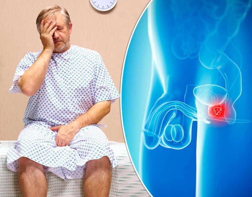 Un uomo con prostatite viene sottoposto a diagnosi della malattia