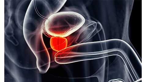 Infiammazione della ghiandola prostatica